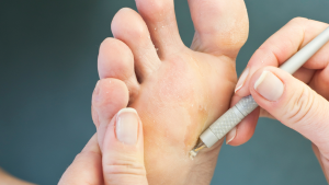 Foot Callus Removal