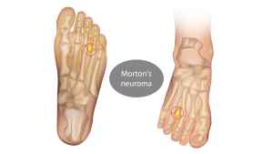 What is Mortons Neuroma