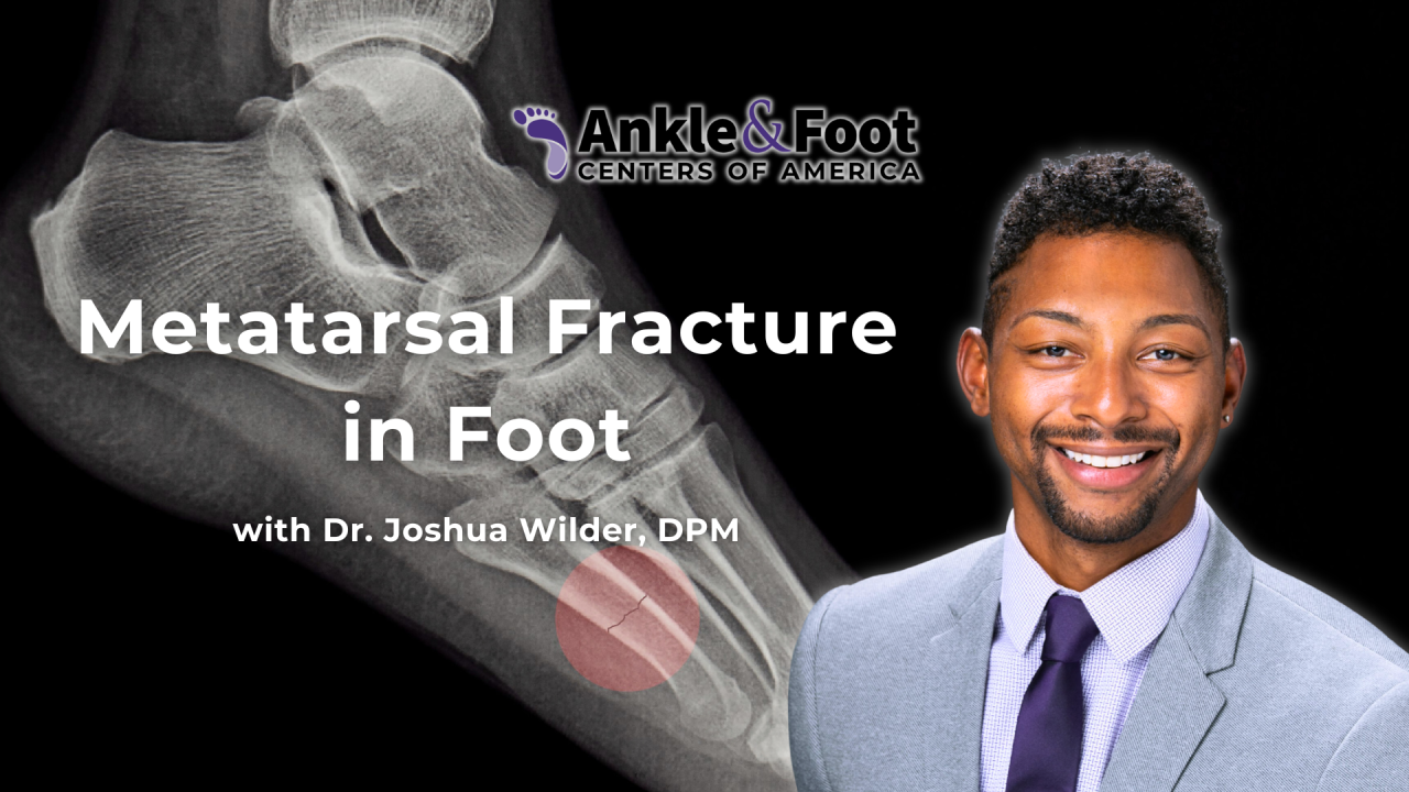 Metatarsal Fracture in the Foot | Ankle & Foot Centers