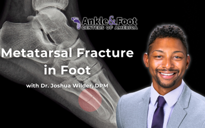 Metatarsal Fracture in Foot