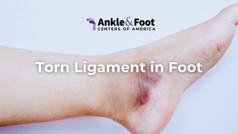 Torn Ligament in Foot | Ankle & Foot Centers of America