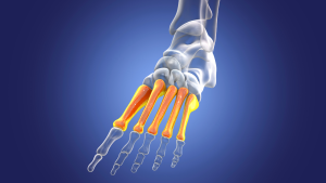 What Is A Metatarsal Fracture
