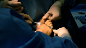 Bunion Surgery