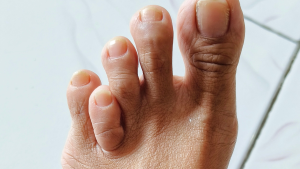 Toe Lengthening Surgery