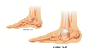 Charcot Foot Reconstruction Surgery