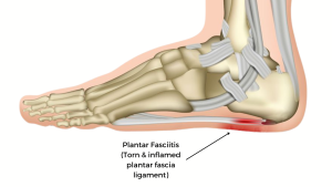 Plantar Fasciitis Specialist