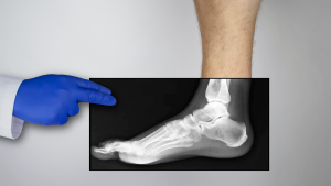 Plantar Fasciitis Treatment Surgery