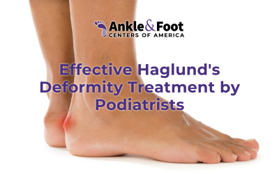 Effective Haglund’s Deformity Treatment by Podiatrists