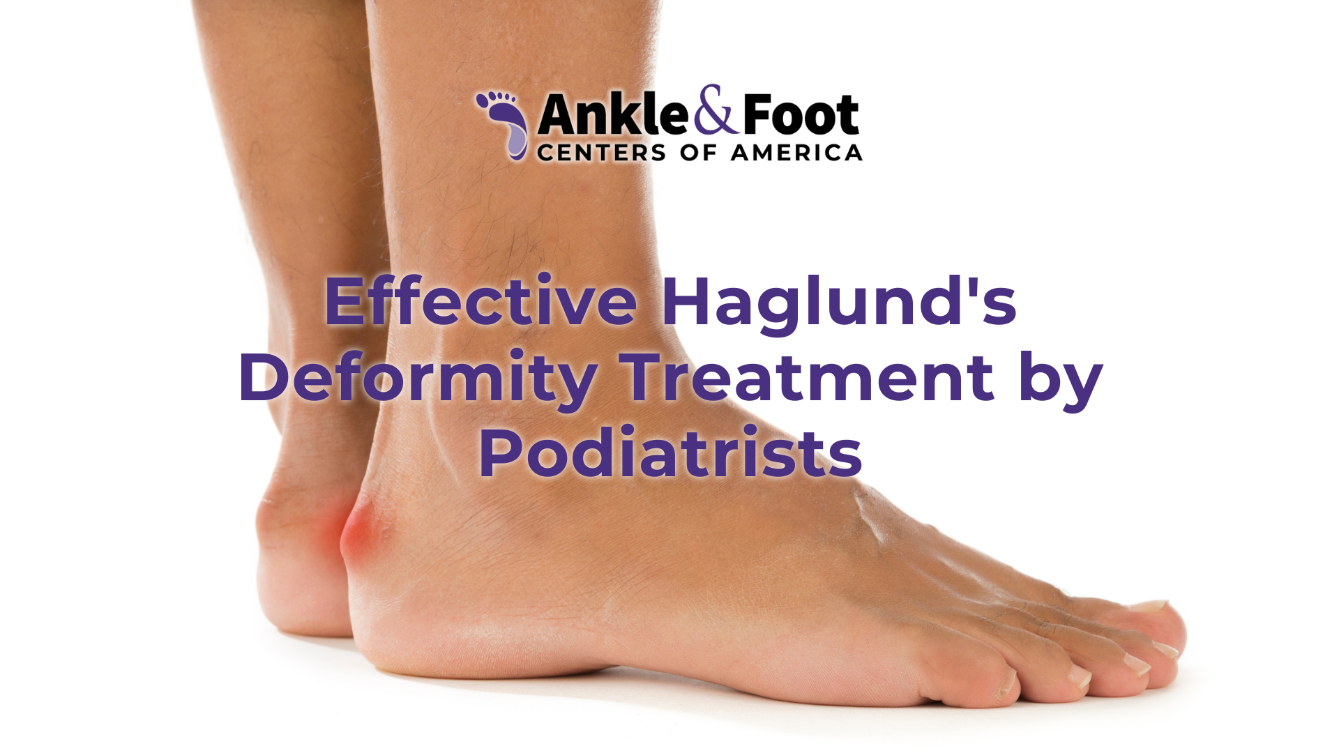 Effective Haglund s Deformity Treatment By Podiatrists Effective Haglund s Deformity Treatment By Podiatrists