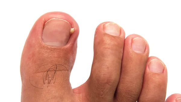 Ingrown Toenail