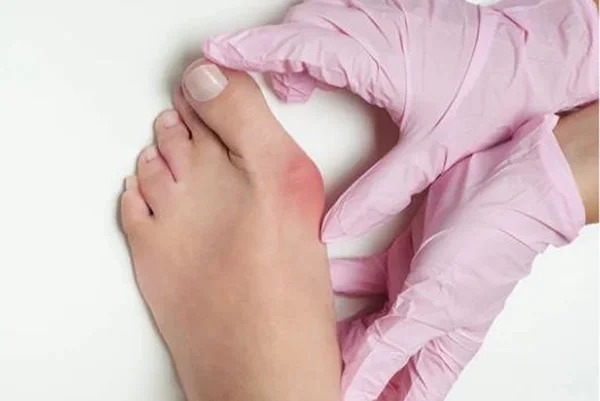 Minimally Invasive Bunion Surgery