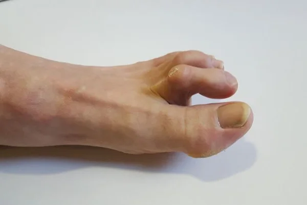 Non Surgical Hammertoe Treatments