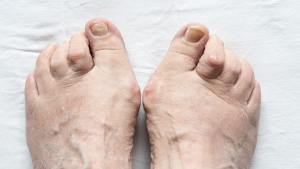 What Causes Hammertoe 