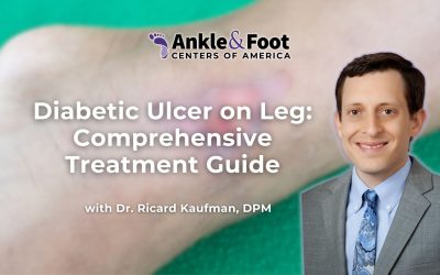 Diabetic Ulcer on Leg: Comprehensive Treatment Guide