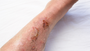 Venous Ulcer Symptoms