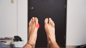 Minimally Invasive Bunion Surgery Recovery Time