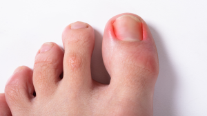 How To Treat Ingrown Toenail