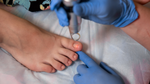 Laser Treatment for Toenail Fungus