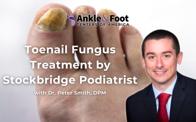 Toenail Fungus Treatment by Stockbridge Podiatrist