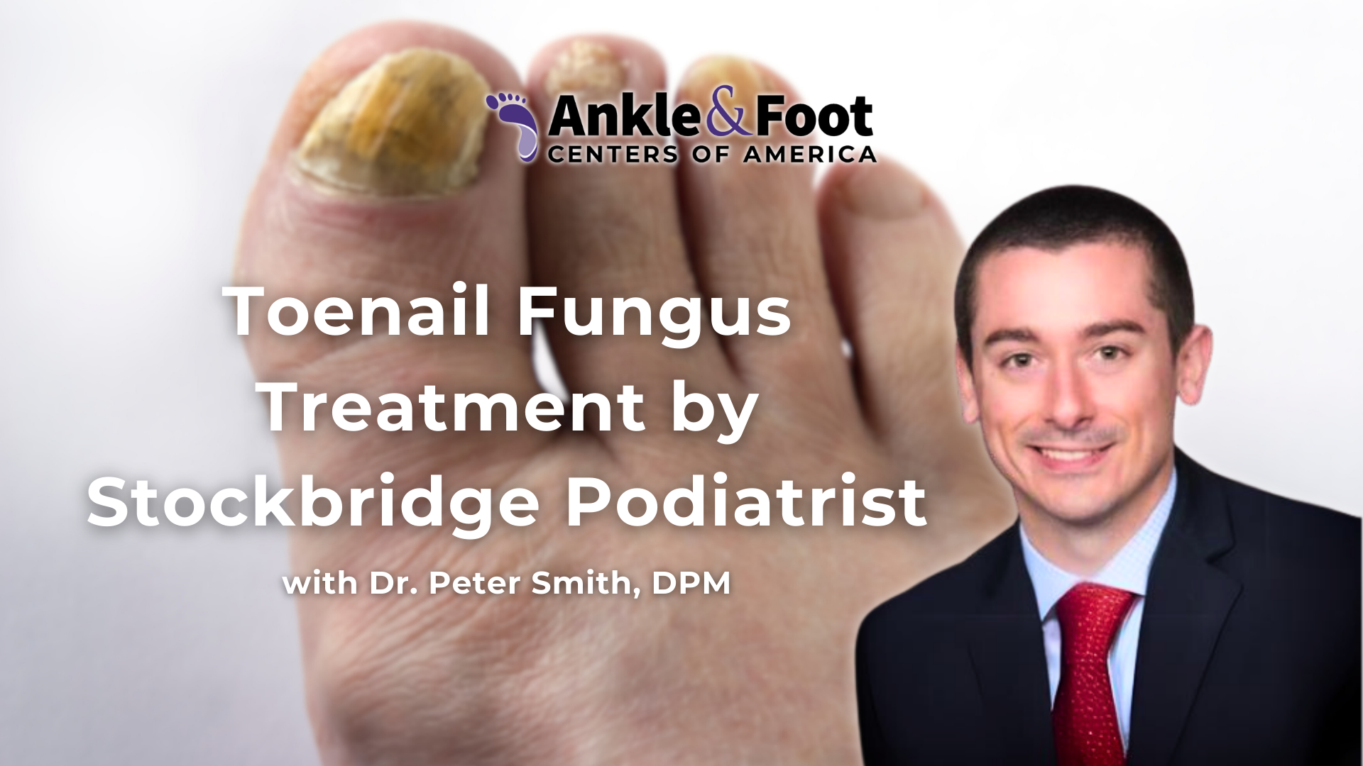 Toenail Fungus Treatment Stockbridge, GA