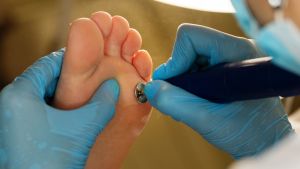 Plantar Callus Treatment