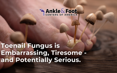 Toenail Fungus is Embarrassing, Tiresome – and Potentially Serious.