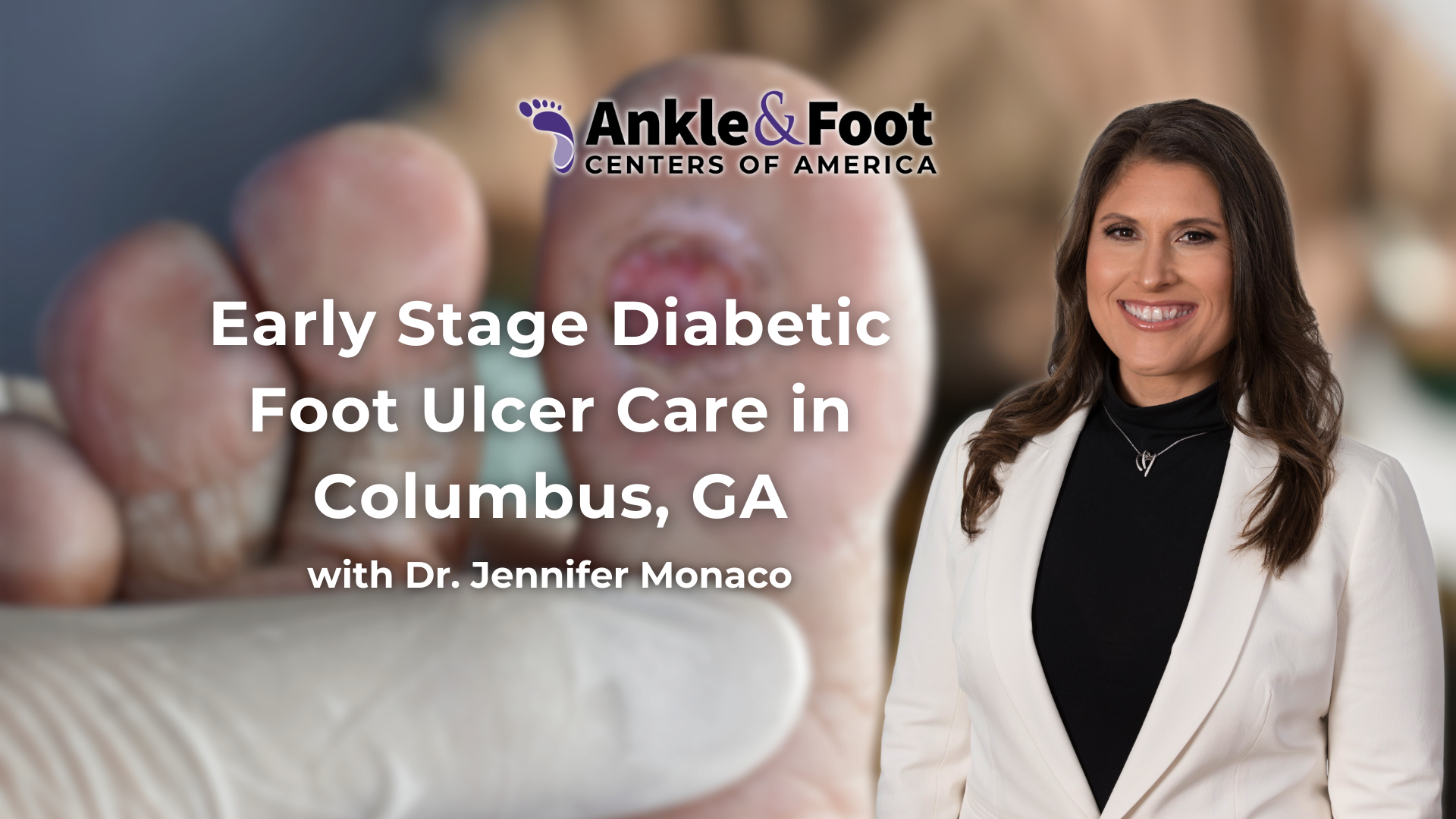 Early Stage Diabetic Foot Ulcer Columbus, Ga