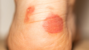 Early Stage Diabetic Foot Ulcer On Toe