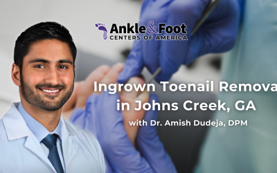 Ingrown Toenail Removal in Johns Creek, GA.