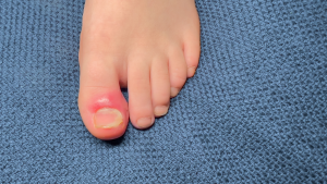 What Does an Ingrown Toenail Look Like