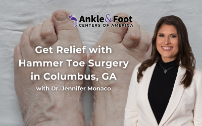 Get Relief with Hammer Toe Surgery in Columbus, GA