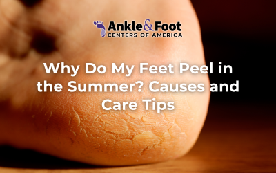 Why Do My Feet Peel in the Summer? Causes and Care Tips