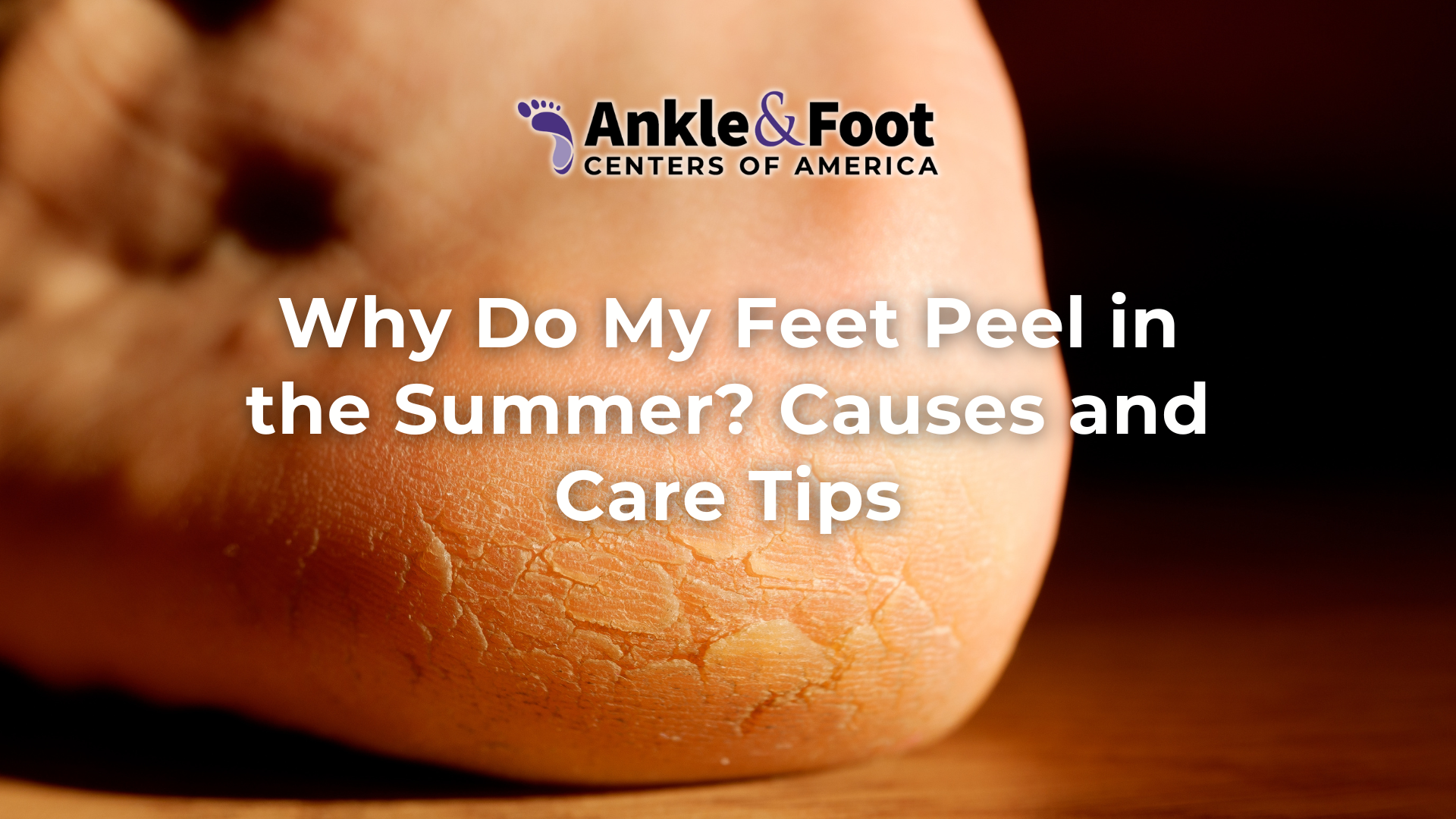 Why Do My Feet Peel In The Summer