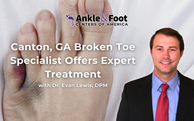 Canton, GA Broken Toe Specialist Offers Expert Treatment