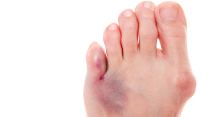 Broken Toe Symptoms