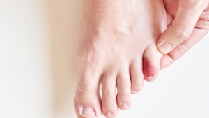 What Does a Broken Toe Look Like