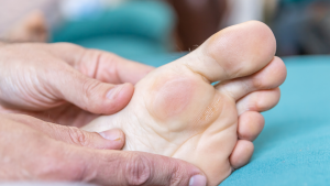 Early Stage Diabetic Foot Ulcer