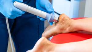 Laser Therapy For Plantar Fasciitis