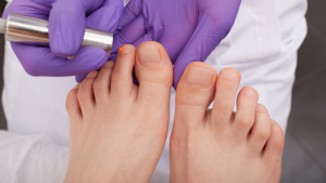 Laser Therapy For Toenail Fungus