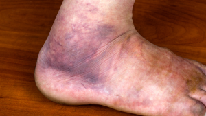 What Does A Broken Foot Look Like