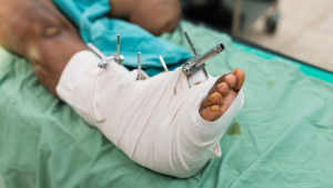 External Fixation