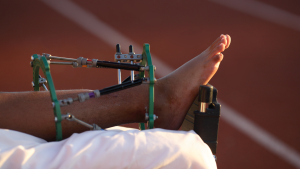 Halo External Fixation Device