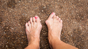 What Does A Bunion Look Like