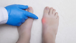 Bunion Care
