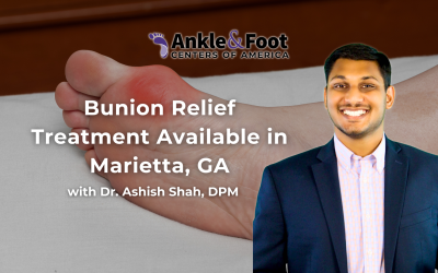 Bunion Relief Treatment Available in Marietta, GA