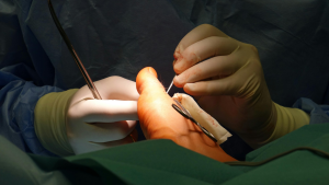 Hammertoe Surgery