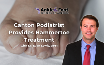 Best Hammertoe Treatment in Canton, GA