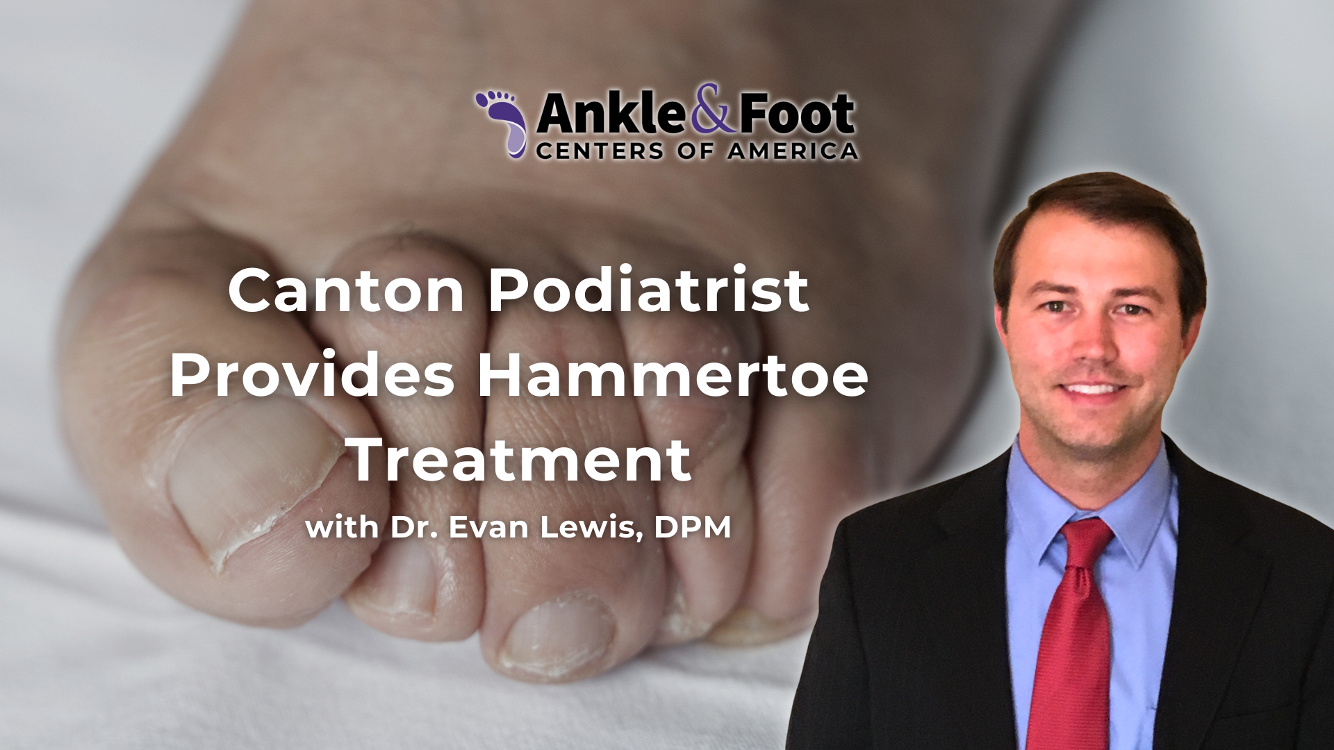 Hammertoe Treatment Canton GA