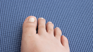 Ingrown Toenail