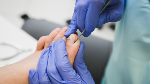 Ingrown Toenail Treatment